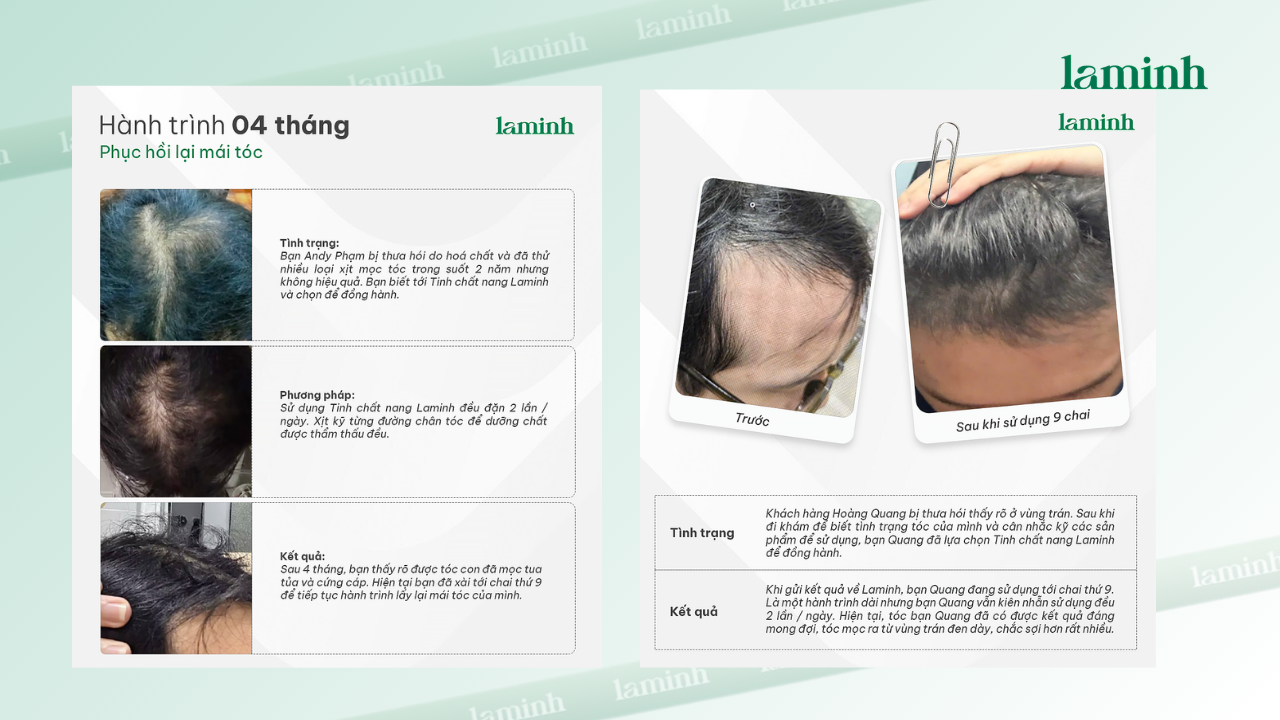 serum mọc tóc an toàn, dùng bao lâu tóc mọc lại, redensyl hỗ trợ mọc tóc, laminh haircare